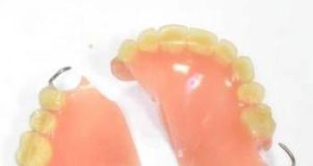 Как осуществляется ремонт зубных протезов Приклеить приварить акриловый зуб к протезу
